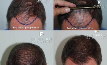 Hair transplantation surgery before and after photos