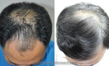 Top view before and after hair restoration results