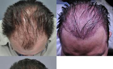 Hair transplantation surgery before and after photos