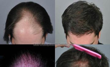 Top view before and after hair restoration results