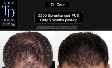 Hair restoration procedure before and after results