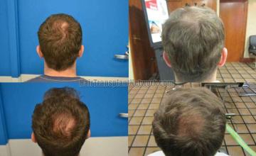 Hair transplantation surgery before and after images