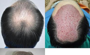 Hair transplantation surgery before and after images