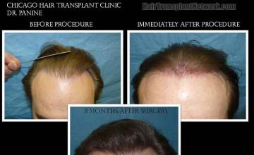 Before and after hair transplant procedure images