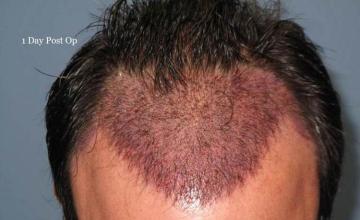 Hair restoration procedure immediate postoperative