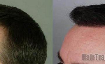 Hair transplant patient pictures viewing left side