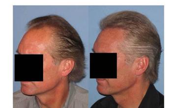 Hair restoration procedure results