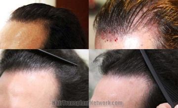 Hair restoration procedure before and after results