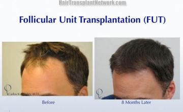 Hair transplantation surgery before and after pictures