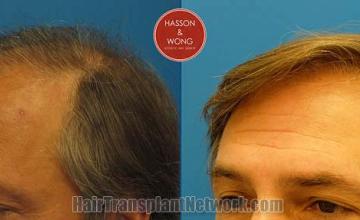 Hair transplantation surgery before and after pictures