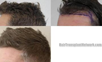 Hair transplantation surgery before and after pictures