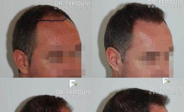 Hair transplantation surgery before and after images