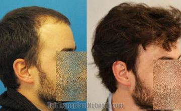 Before and after hair transplantation result photographs