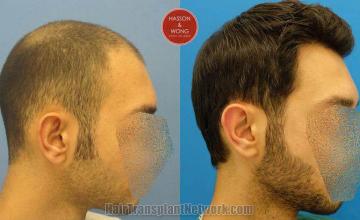 Hair transplantation surgery before and after images,