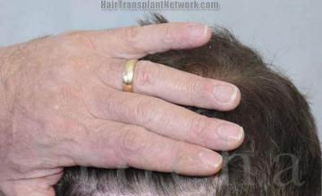 Hair transplantation surgery before and after pictures