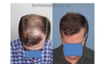 Tilt down view before and after hair restoration