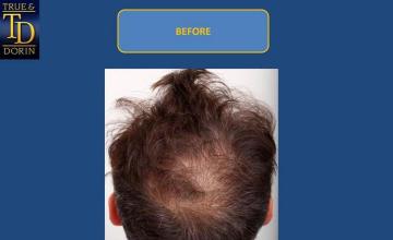 Hair restoration procedure before and after pictures