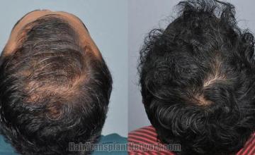 Hair transplantation surgery before and after images