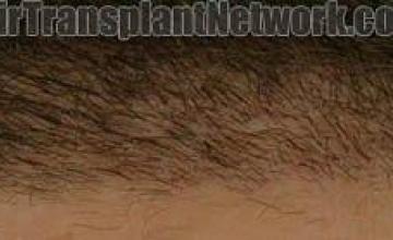 Closeup hairline views of hair transplant results