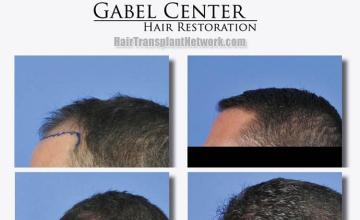 Hair restoration procedure before and after results