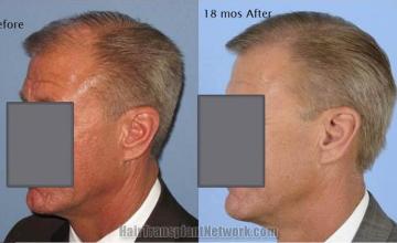 Hair transplantation surgery before and 18 months after pictures