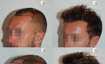 Hair transplantation surgery before and after photos