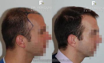 Hair restoration procedure before and after results