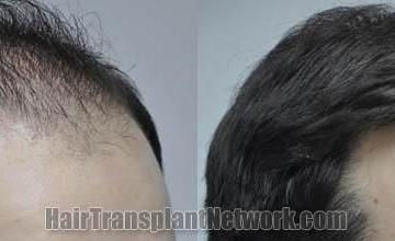 Hair restoration procedure before and after results