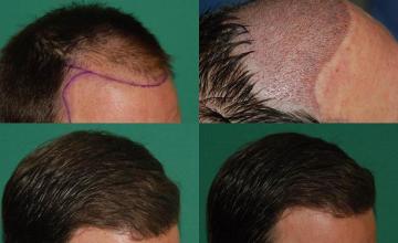 Hair transplantation surgery before and after images