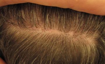 Residual donor scar area after hair transplant