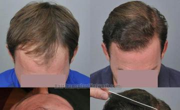 Top view before and after hair restoration results