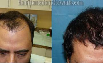 Top view before and after hair restoration procedure