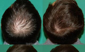 Hair restoration procedure before and after results