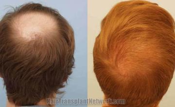 Hair restoration procedure before and after results