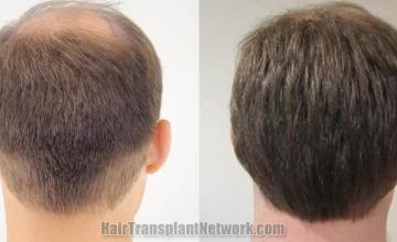 Hair restoration procedure before and after pictures