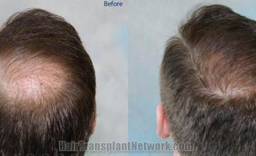 Crown hair transplant before and after images