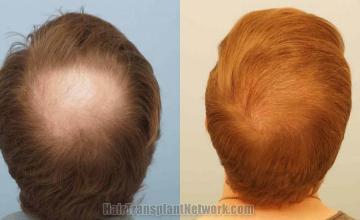 Hair transplantation surgery before and after photos