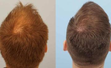 Hair transplantation procedure before and after photographs