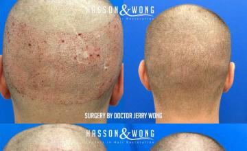 Hair restoration procedure before and after pictures