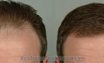 Before and after hair transplantation result photographs