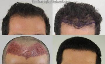 Hair restoration procedure before and after results