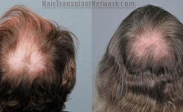 Hair transplantation surgery before and after pictures