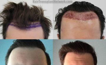 Before and after hair transplant procedure images