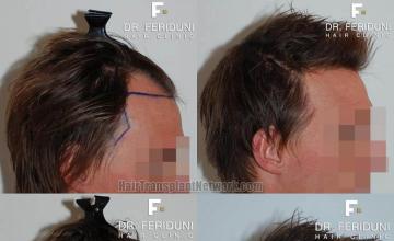 Hair transplantation surgery before and after images