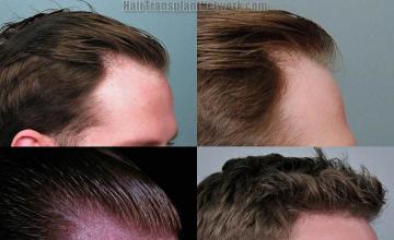 Hair transplantation surgery before and after images