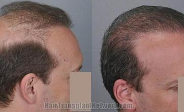 Hair transplantation surgery before and after photos