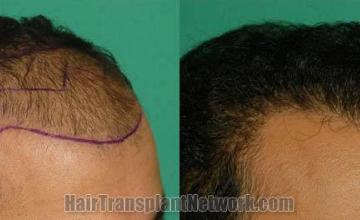 Hair transplantation surgery before and after photos