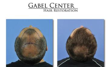 Back view before and after hair transplantation photos