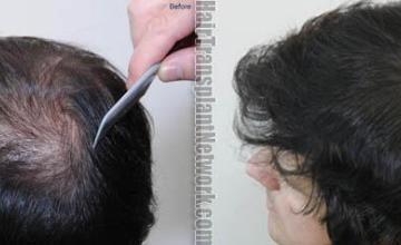 Hair transplantation surgery before and after photos