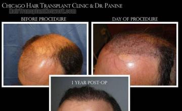 Hair transplantation surgery before and after images